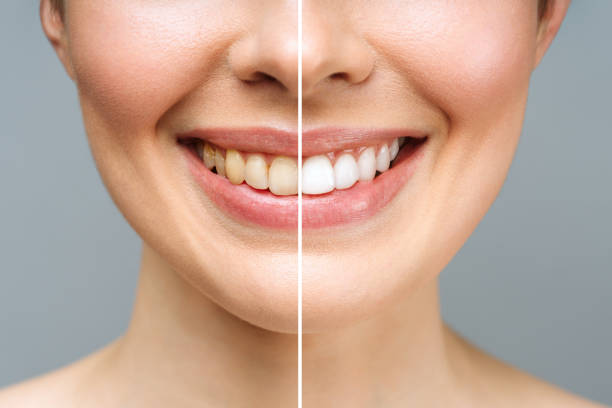 Cherry Dental Financing: Flexible Payment Plans for a Healthier Smile 3 a woman's face with a comparison of teeth
